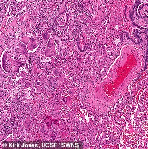 A vaper has been diagnosed with an incurable form of lung scarring typically found in metal factory workers. Her lung tissue under the microscope