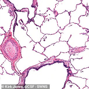 Compared to healthy lung tissue