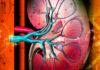 Kidney Disease Solution Resource